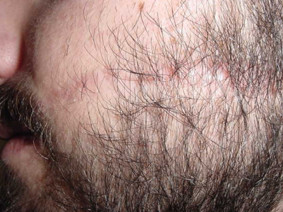 Cicatrice viso foto dopo