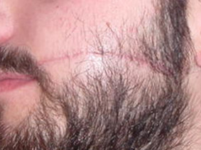 Cicatrice viso foto prima