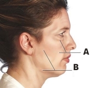 Lifting facciale - Lifting viso