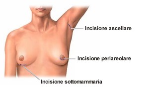Tipi d'incisioni e vie d'accesso per la mastoplastica additiva