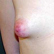 Chirurgia estetica del seno tuberoso