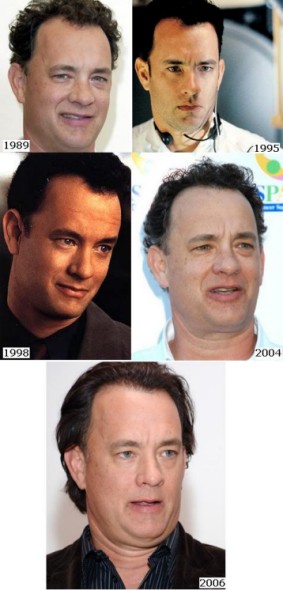 Trapianto capelli Vip - Tom Hanks