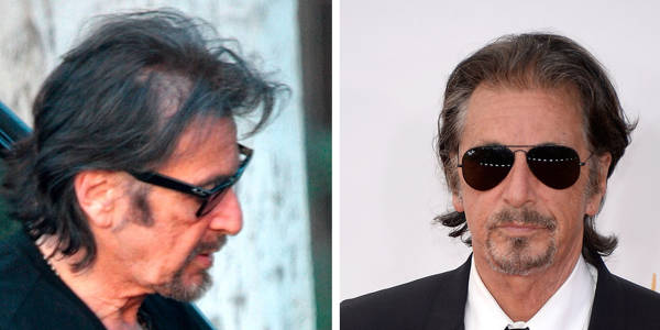 Trapianto capelli Vip - Al Pacino