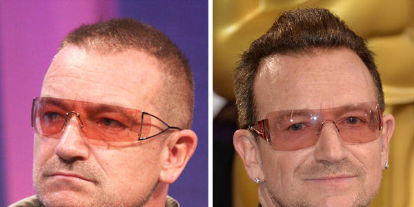 Trapianto capelli Vip - Bono