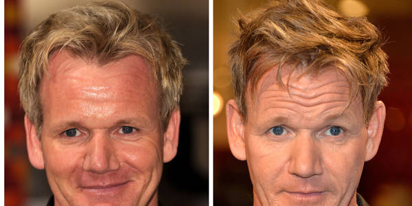 Trapianto capelli Vip - Gordon Ramsay
