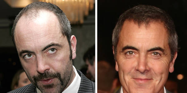 Trapianto capelli Vip - James Nesbitt