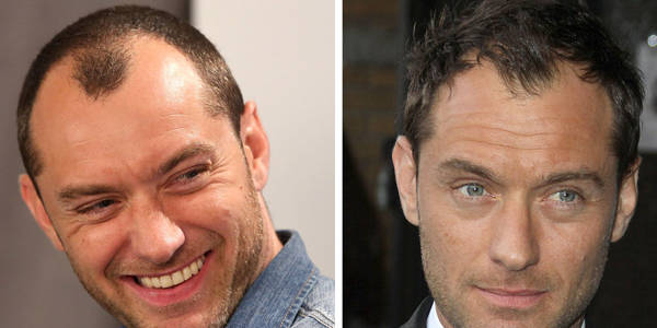 Trapianto capelli Vip - Jude Law