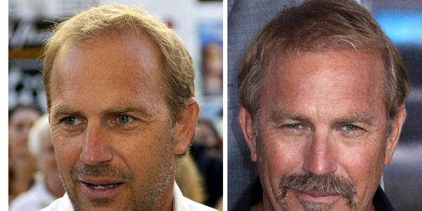 Trapianto capelli Vip - Kevin Costner