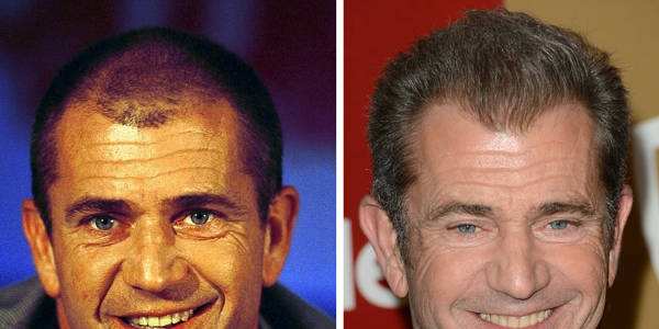 Trapianto capelli Vip - Mel Gibson