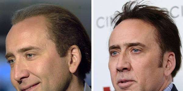 Trapianto capelli Vip - Nicolas Cage