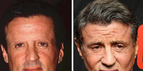 Trapianto capelli Vip - Sylvester Stallone