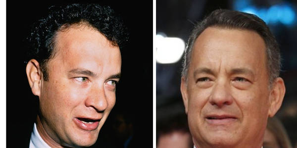 Trapianto capelli Vip - Tom Hanks