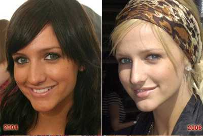 Chirurgia estetica VIP - Ashlee Simpson : Rinoplastica