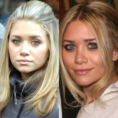 Ashley Olsen : Rinoplastica foto prima e dopo