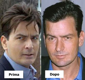 Charlie Sheen - Rinoplastica