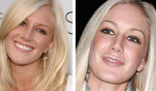 Chirurgia estetica labbra Heidi Montag