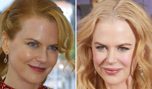 Chirurgia estetica labbra Nicole Kidman