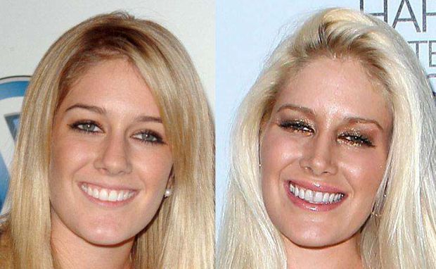 Chirurgia estetica Heidi Montag - Amerie: Rinoplastica