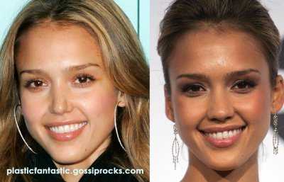 Jessica Alba: Rinoplastica