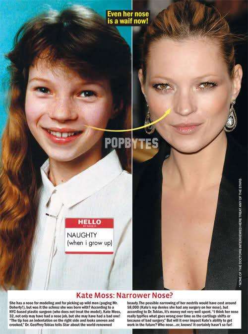 Chirurgia estetica Kate Moss - Amerie: Rinoplastica