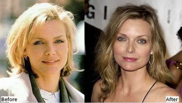 Michelle Pfeiffer - Rinoplastica