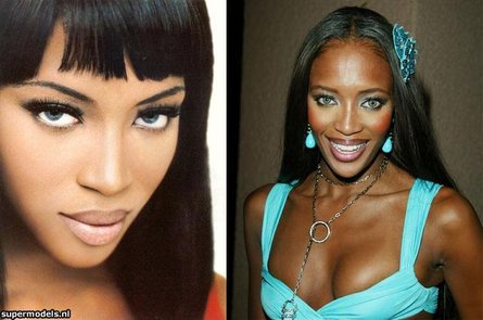 Naomi Campbell - Rinoplastica