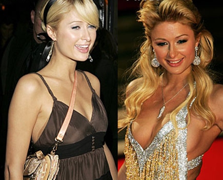 Mastoplastica additiva Vip - Paris Hilton