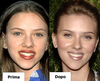 Scarlett Johansson - Rinoplastica